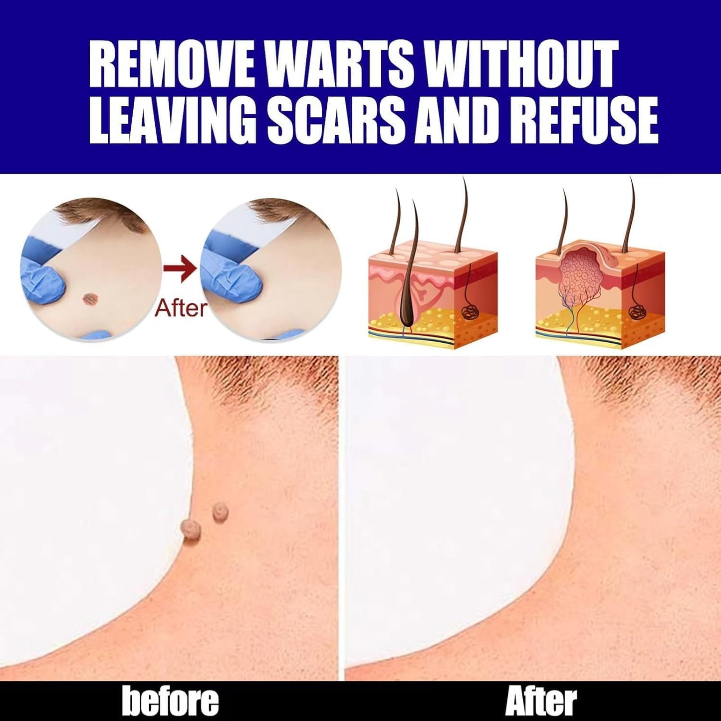 Warts Remover Ointment – Fast, Gentle & Effective Treatment for Warts