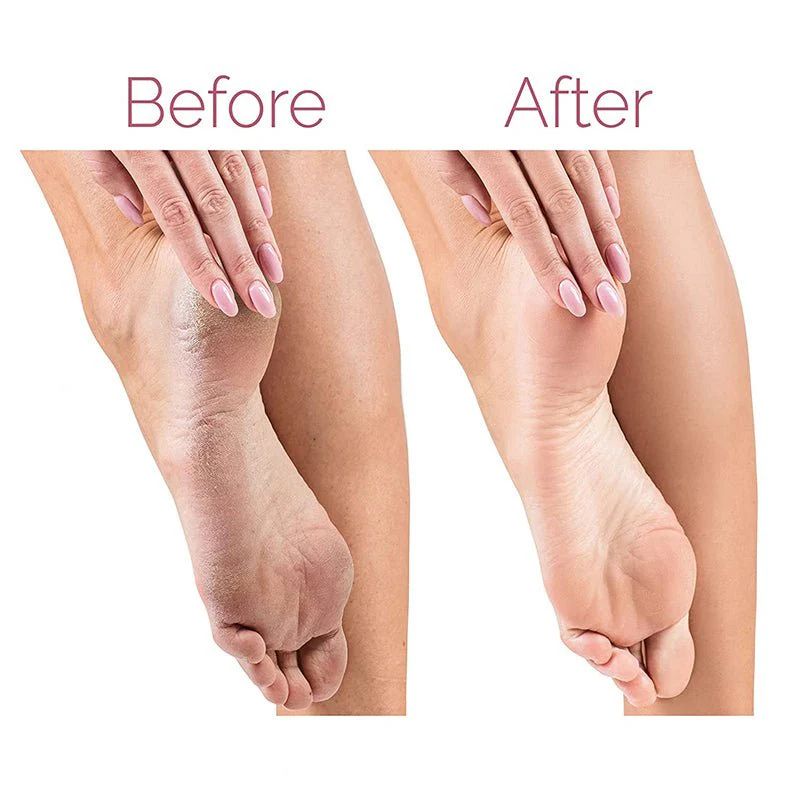 SoftFeet Callus Remover